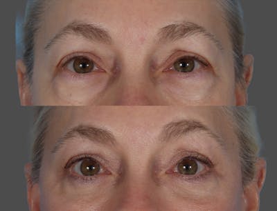 Eyelid Surgery (Blepharoplasty) Before & After Gallery - Patient 385345 - Image 1