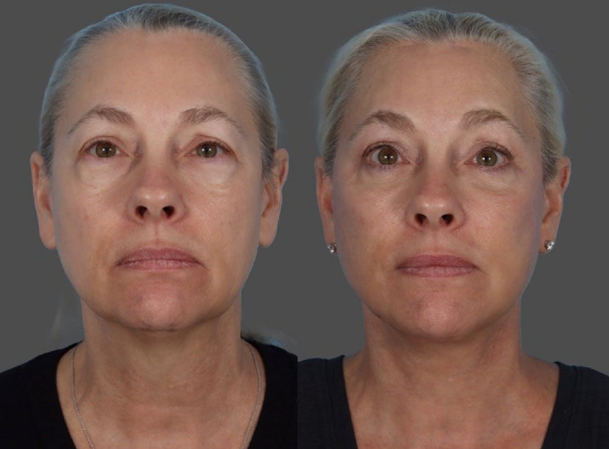 Facelift Before & After Gallery - Patient 112252 - Image 1