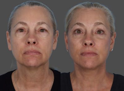 Facelift Before & After Gallery - Patient 112252 - Image 1