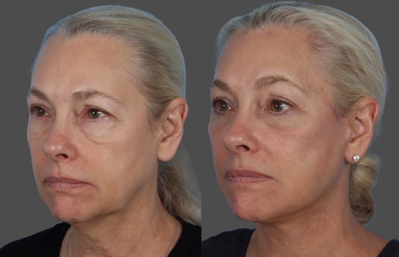 Facelift Before & After Gallery - Patient 112252 - Image 4