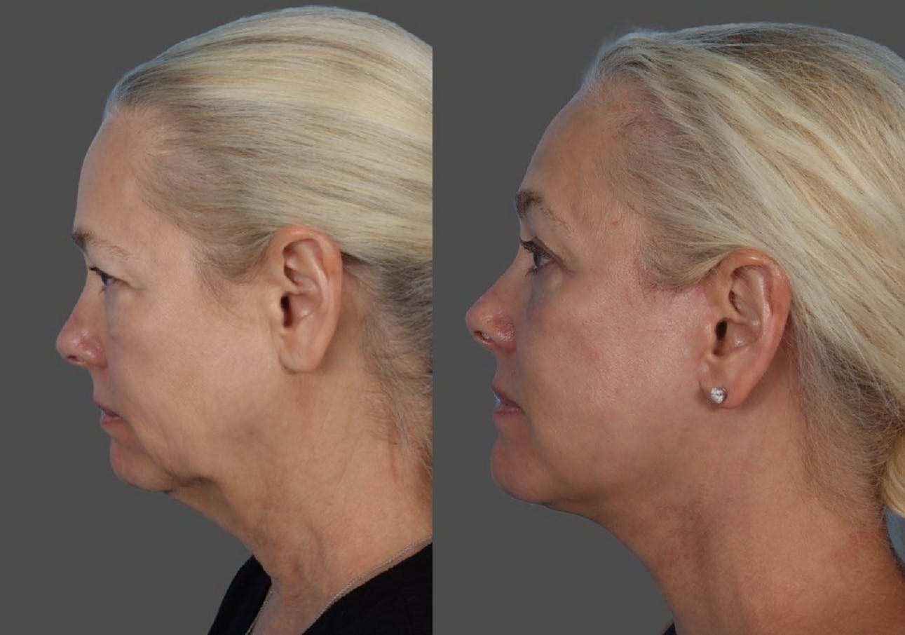 Facelift Before & After Gallery - Patient 112252 - Image 5