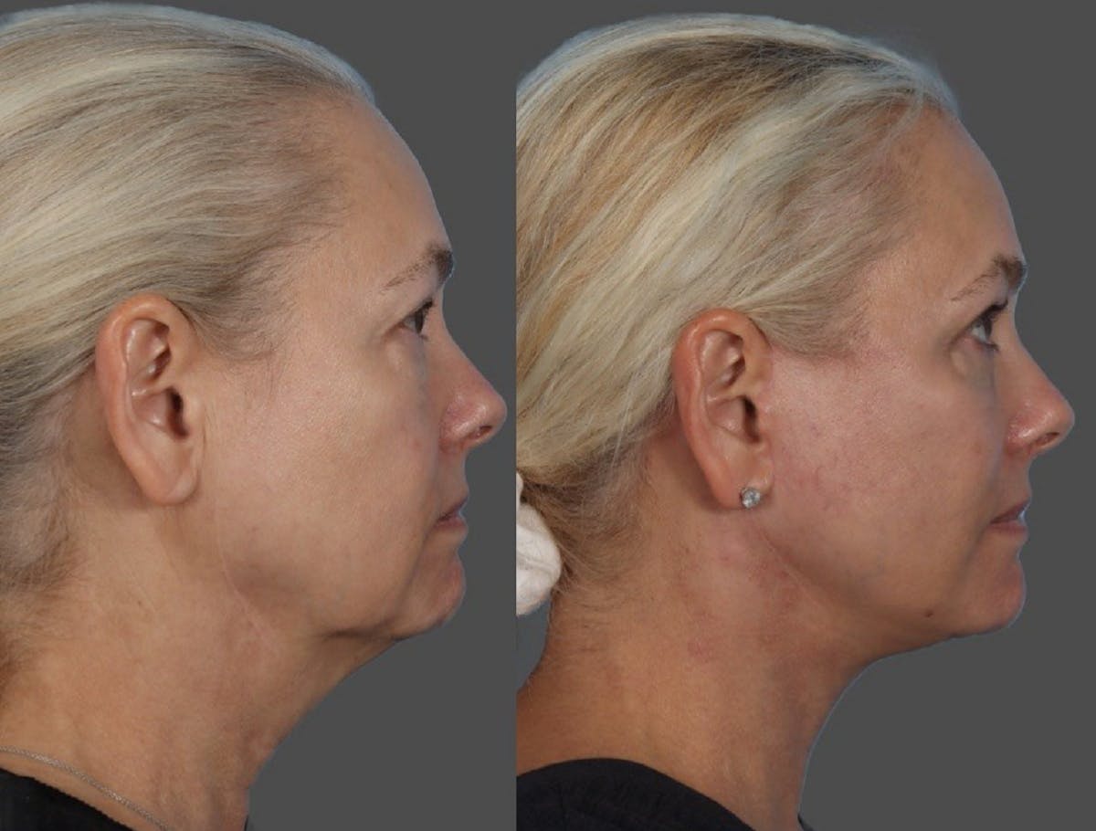 Facial Fat Transfer Before & After Gallery - Patient 253068 - Image 3