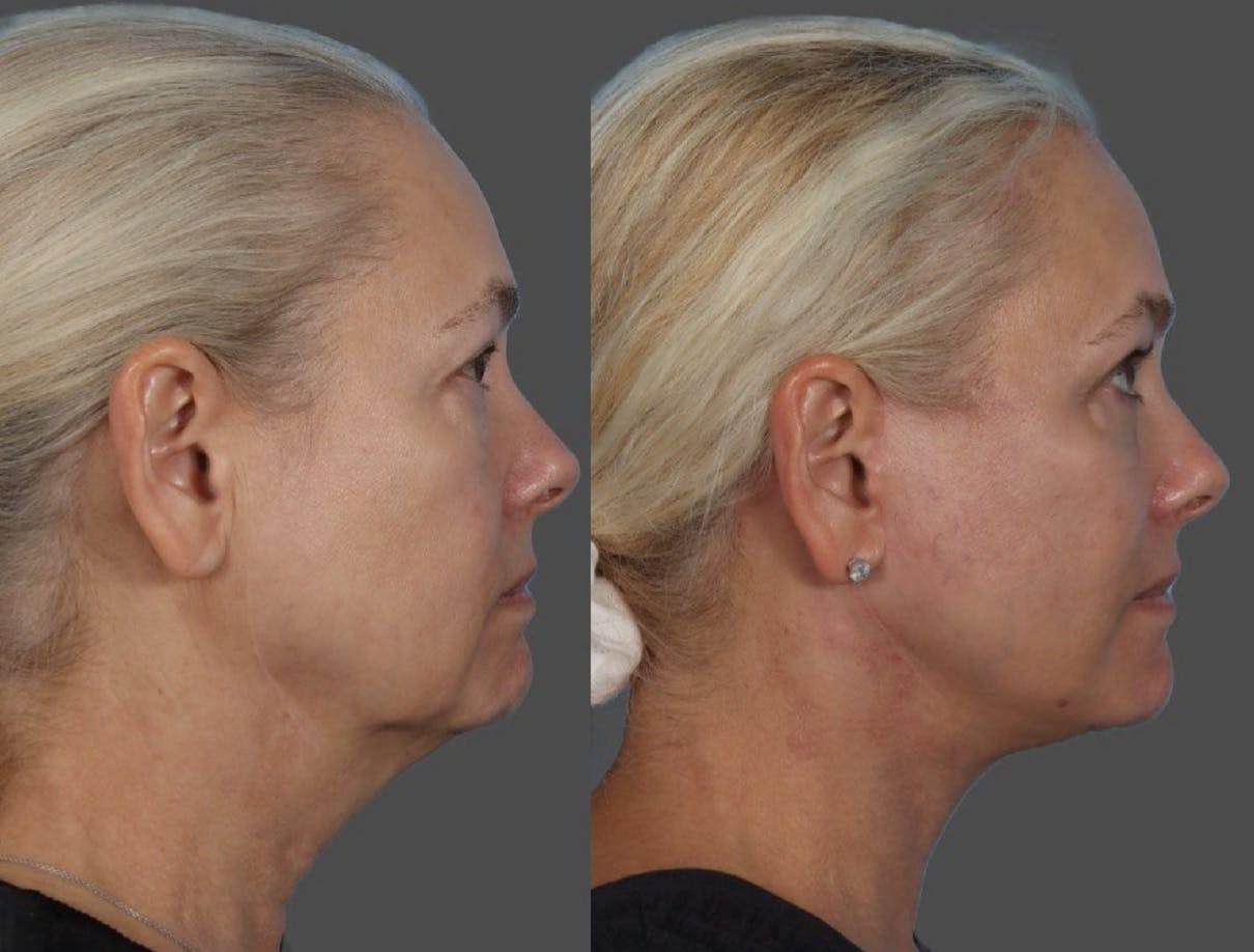 Facelift Before & After Gallery - Patient 112252 - Image 3