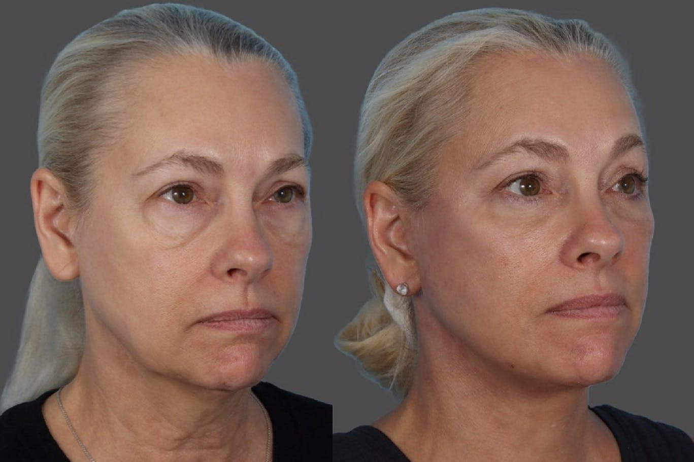 Facelift Before & After Gallery - Patient 112252 - Image 2