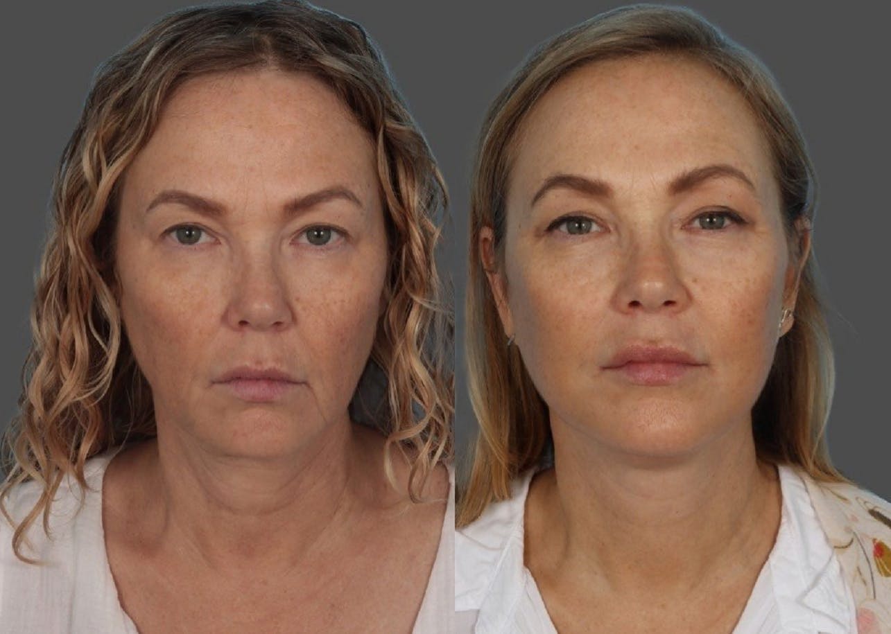 Facelift Before & After Gallery - Patient 247891 - Image 1