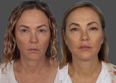 Facelift Before & After Gallery - Patient 247891 - Image 1