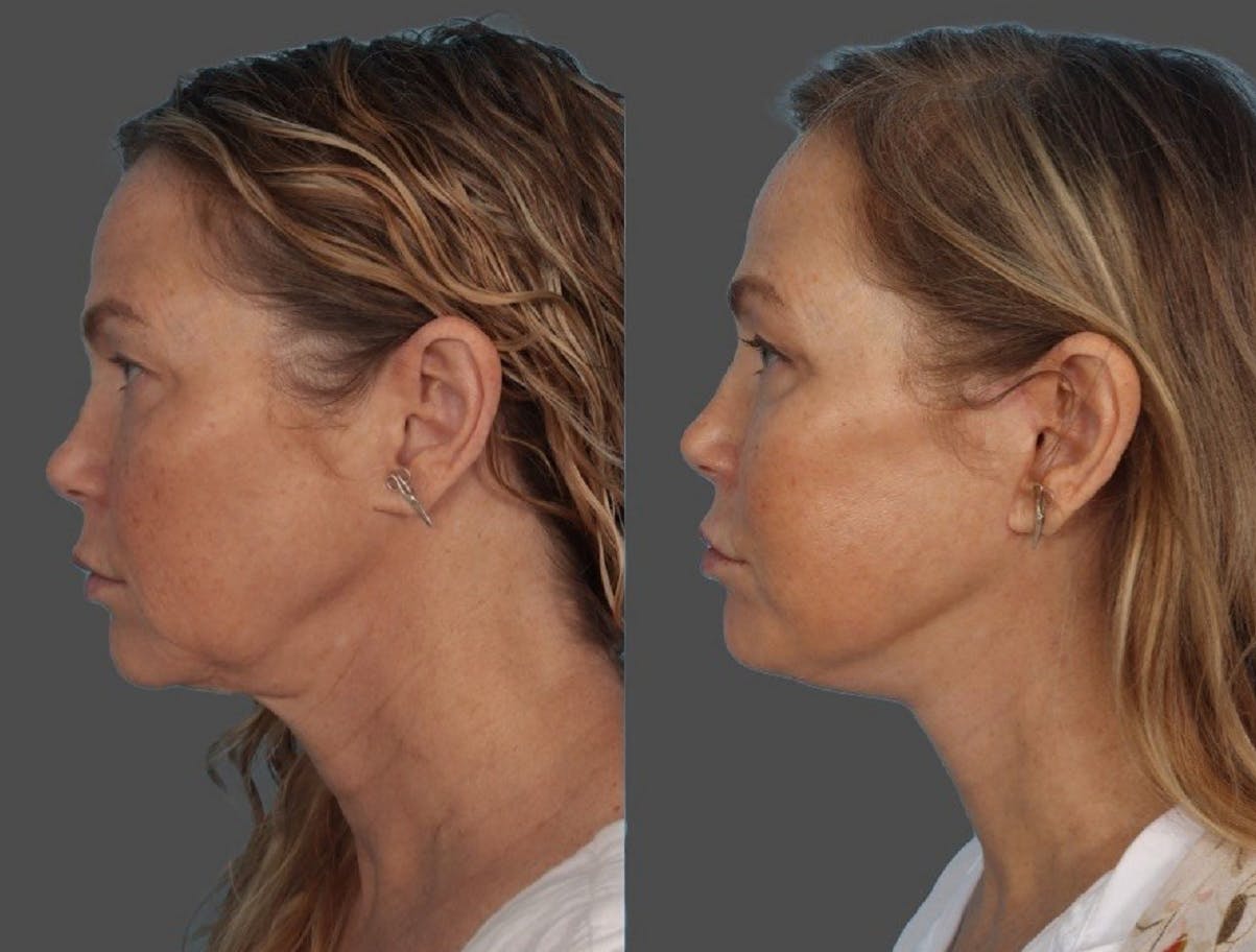 Facelift Before & After Gallery - Patient 247891 - Image 2