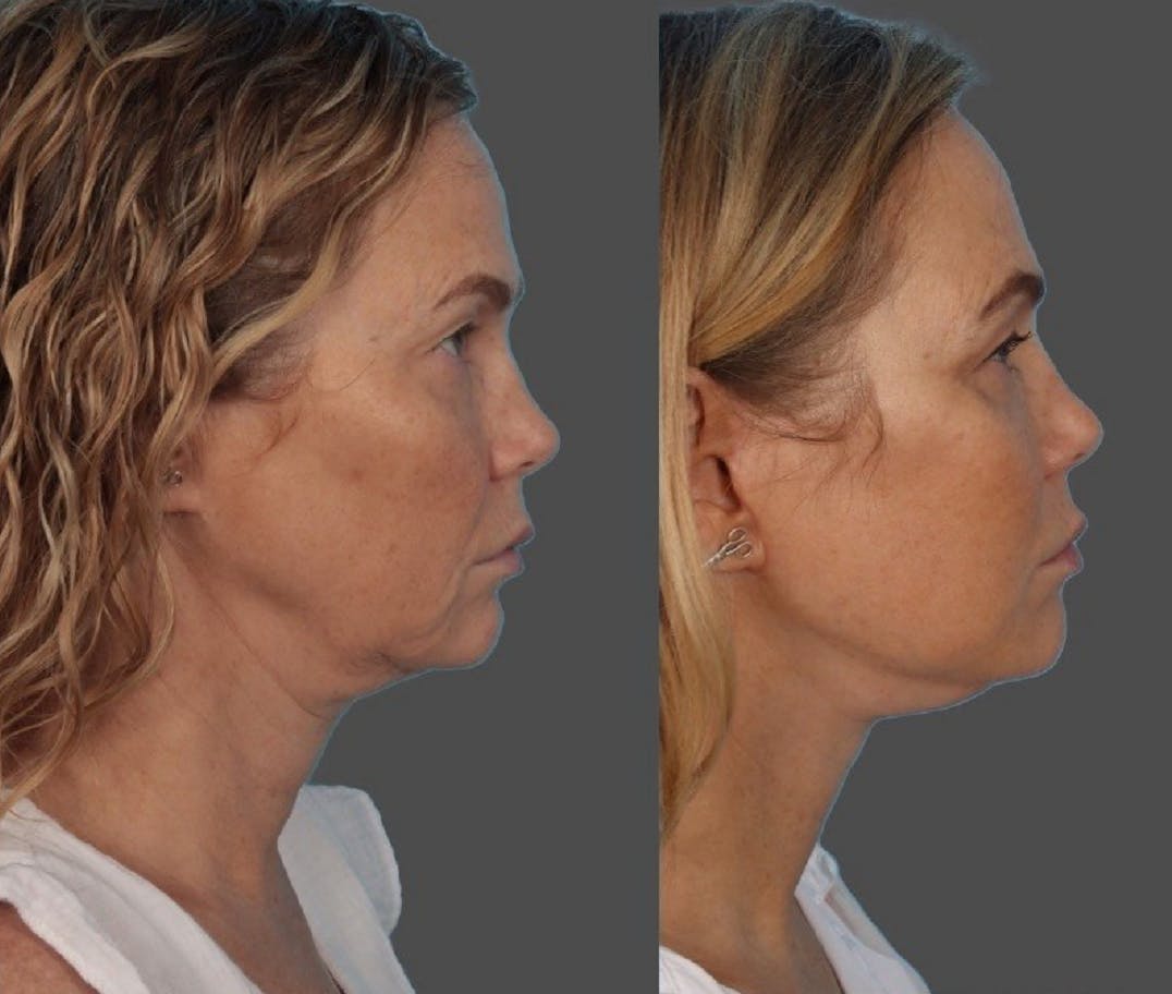 Facelift Before & After Gallery - Patient 247891 - Image 5