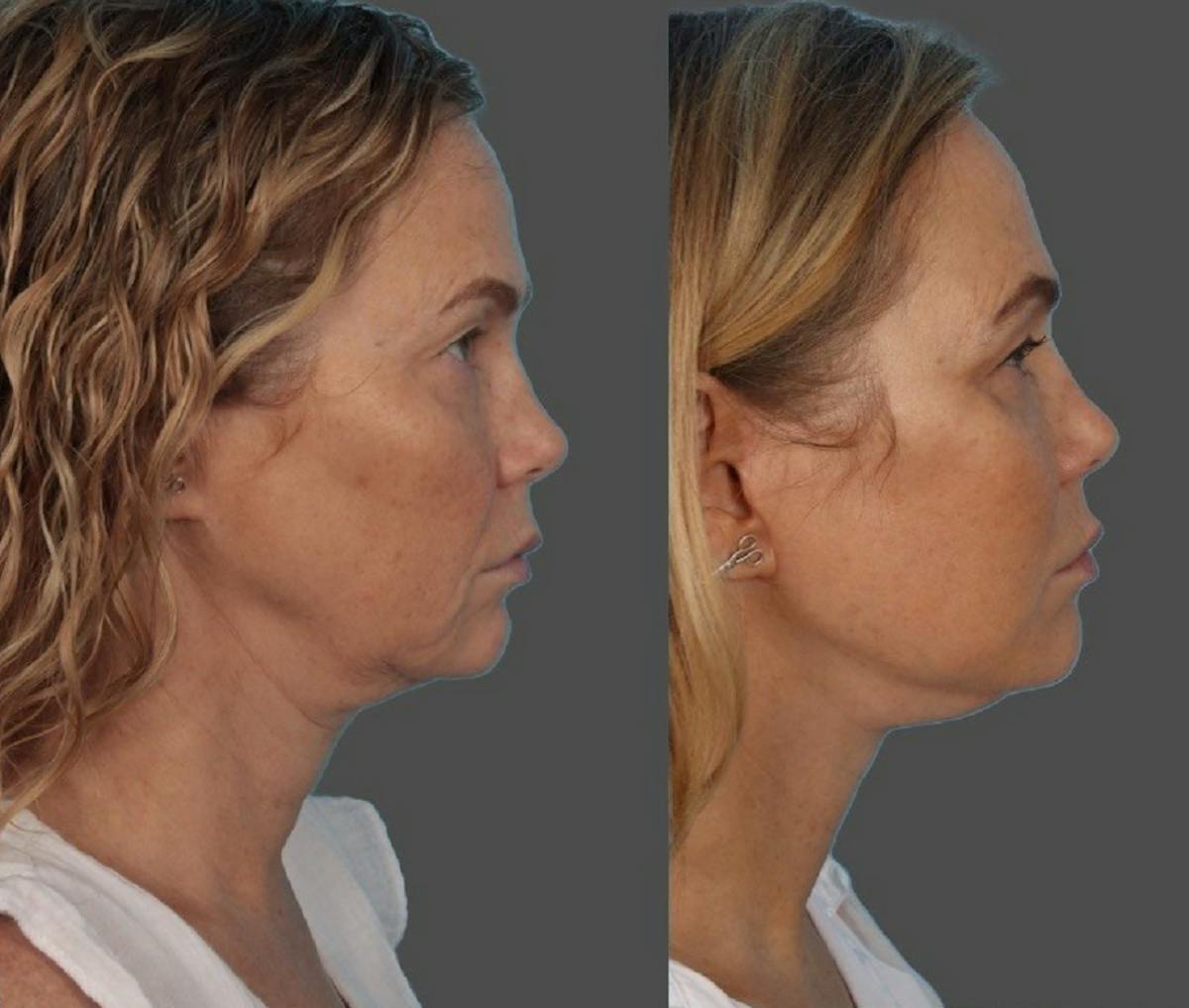Facelift Before & After Gallery - Patient 247891 - Image 5