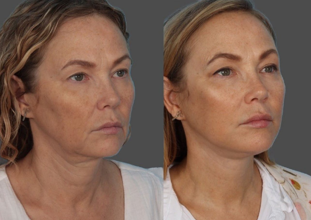 Facelift Before & After Gallery - Patient 247891 - Image 4