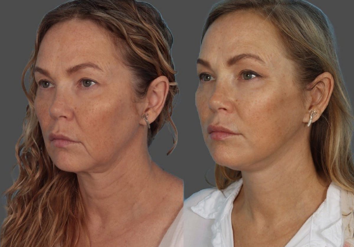 Facelift Before & After Gallery - Patient 247891 - Image 3