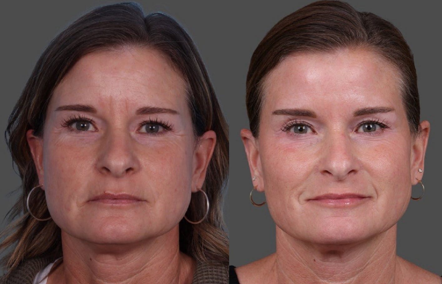 Botox Before & After Gallery - Patient 417647 - Image 1