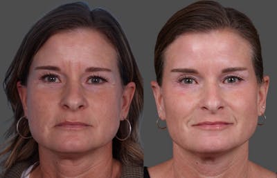 Botox Before & After Gallery - Patient 417647 - Image 1