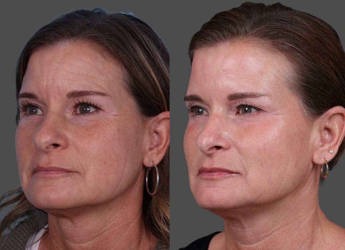 Restylane Before & After Gallery - Patient 398816 - Image 4