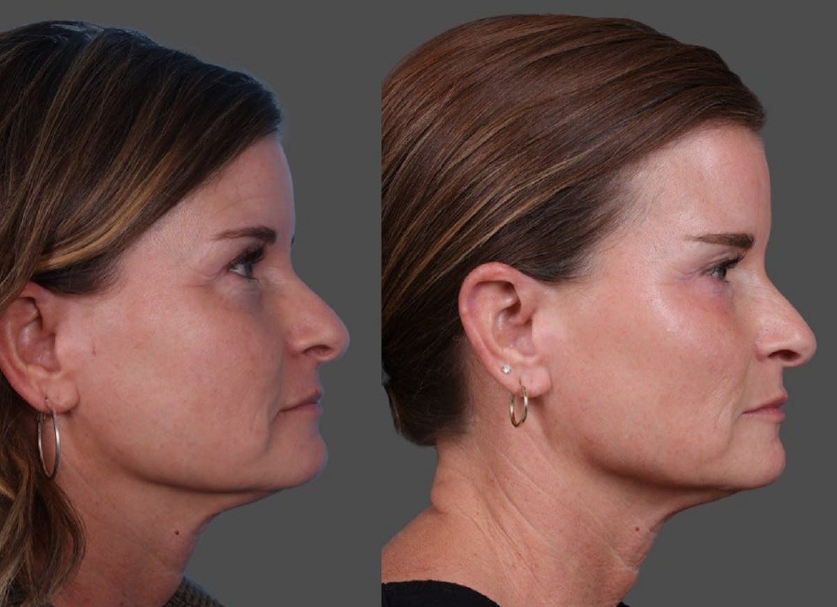 Restylane Before & After Gallery - Patient 398816 - Image 3