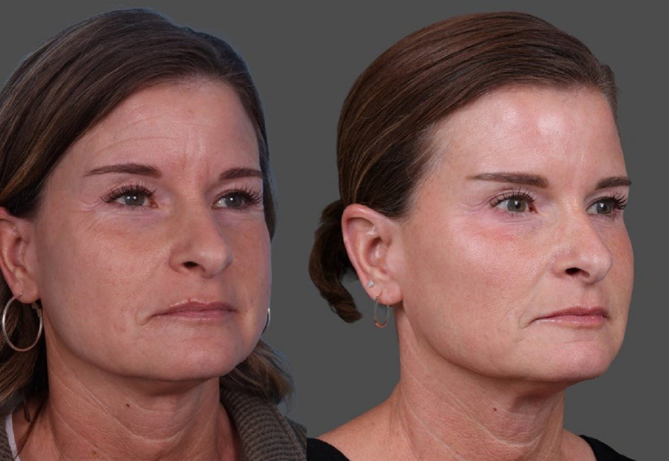 Botox Before & After Gallery - Patient 417647 - Image 2