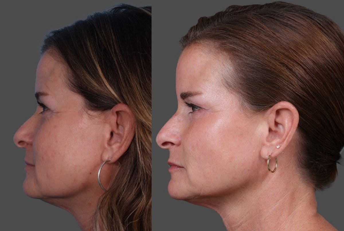 Restylane Before & After Gallery - Patient 398816 - Image 5
