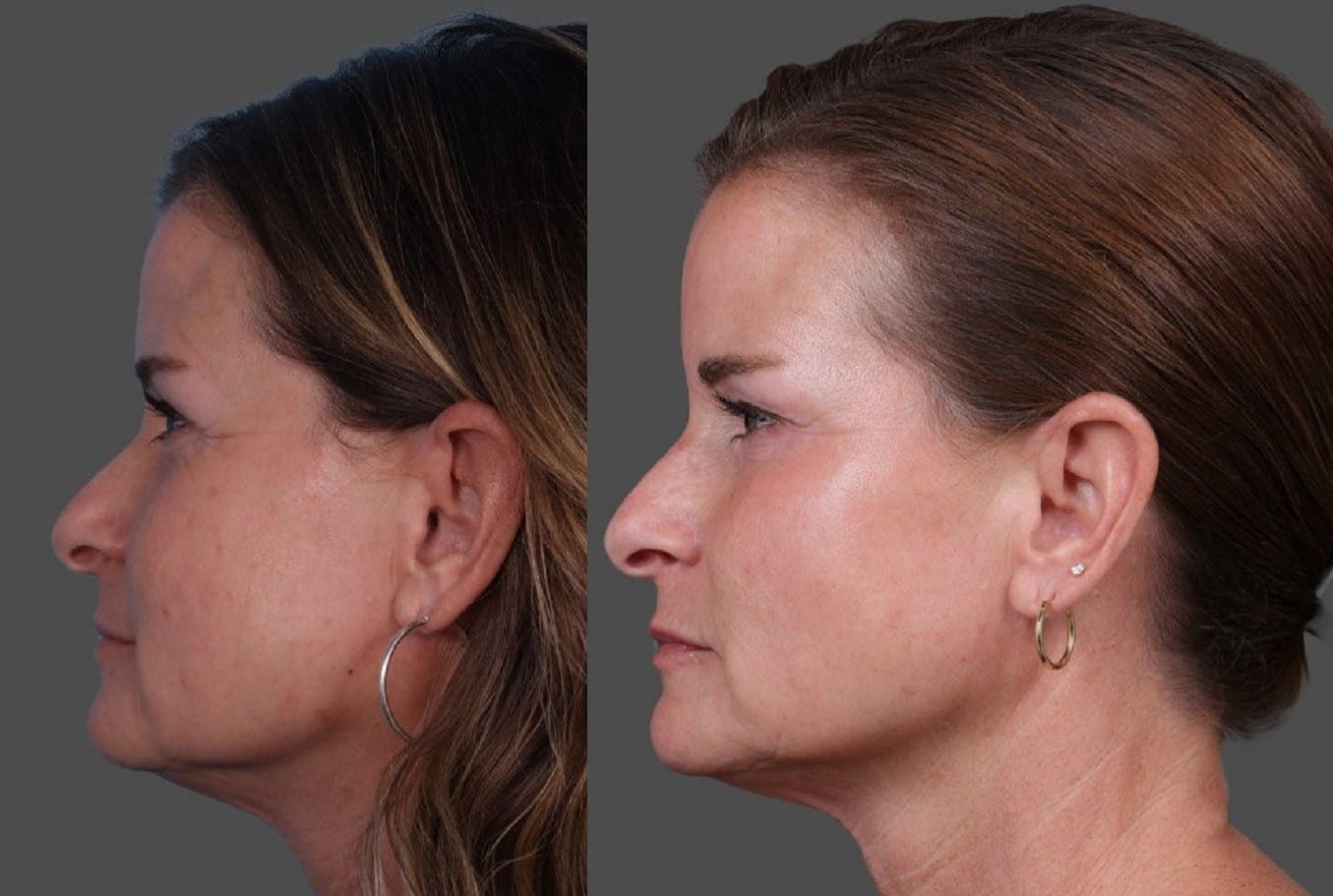 Botox Before & After Gallery - Patient 417647 - Image 5