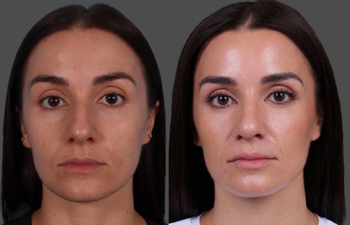 Botox Before & After Gallery - Patient 275469 - Image 1
