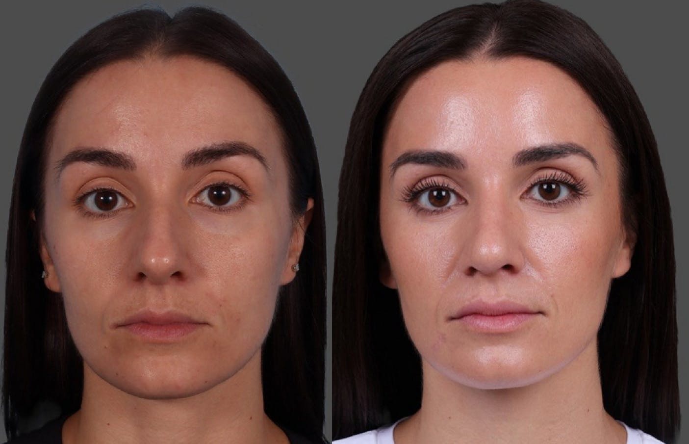 Botox Before & After Gallery - Patient 275469 - Image 1
