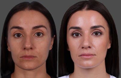 Botox Before & After Gallery - Patient 275469 - Image 1