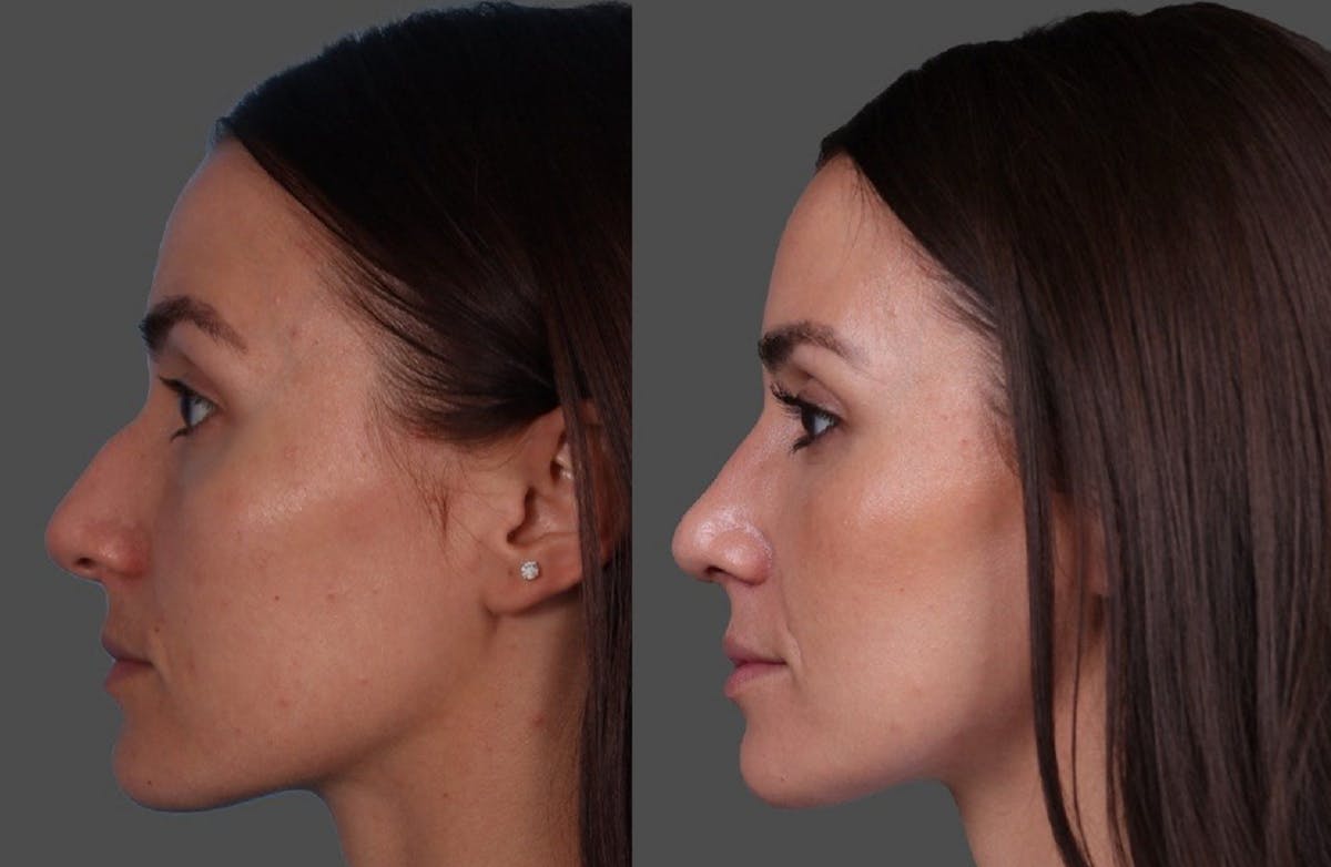 Botox Before & After Gallery - Patient 275469 - Image 5