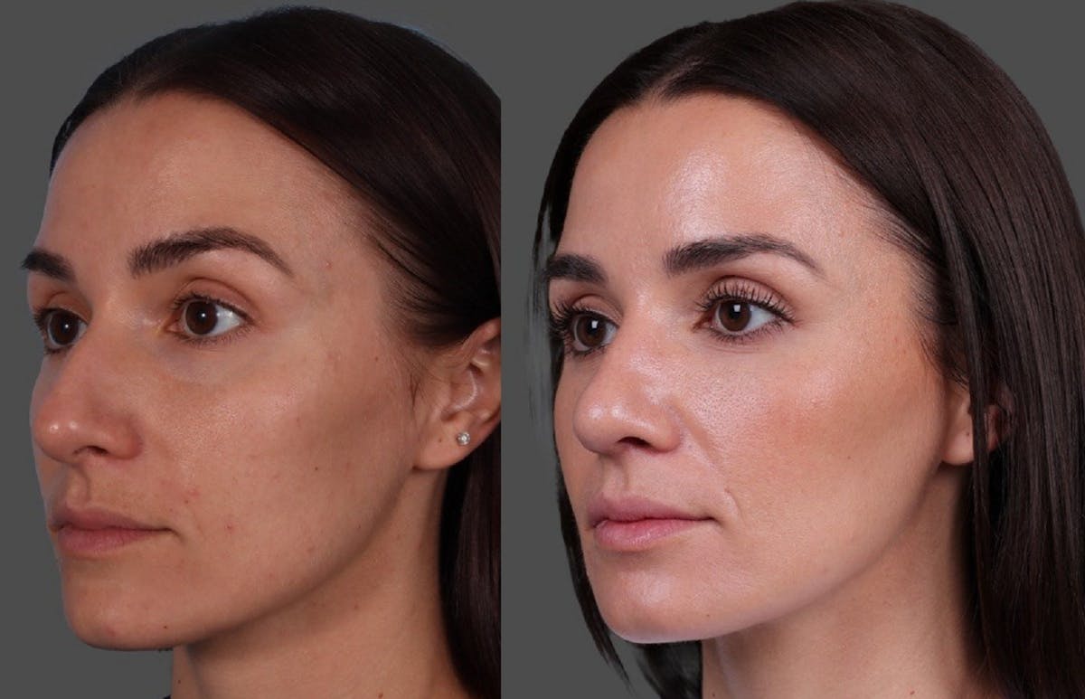 Botox Before & After Gallery - Patient 275469 - Image 4