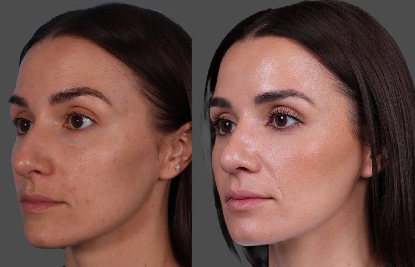 Botox Before & After Gallery - Patient 275469 - Image 4