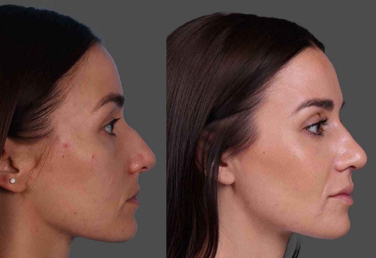 Botox Before & After Gallery - Patient 275469 - Image 3