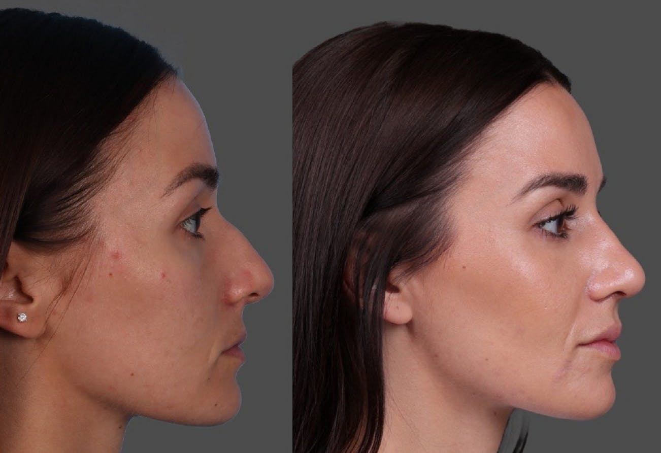 Botox Before & After Gallery - Patient 275469 - Image 3