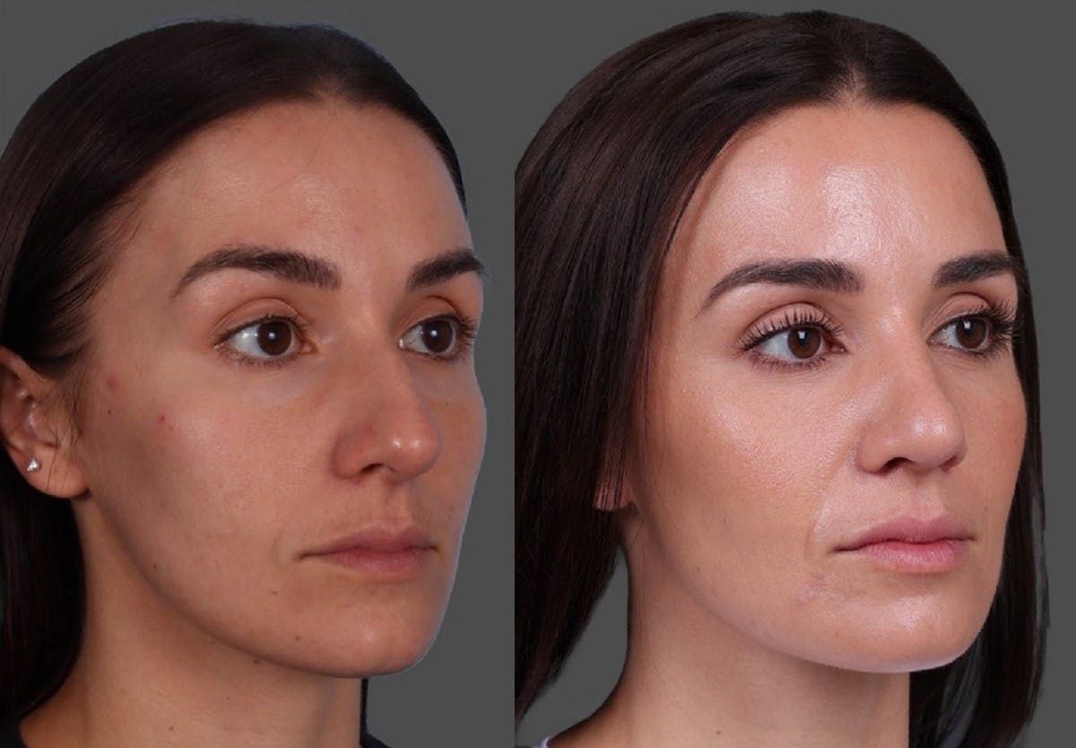 Botox Before & After Gallery - Patient 275469 - Image 2