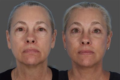 Facelift Before & After Gallery - Patient 112252 - Image 1