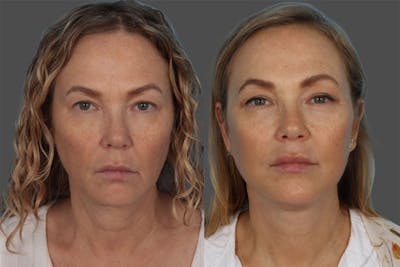 Facelift Before & After Gallery - Patient 247891 - Image 1