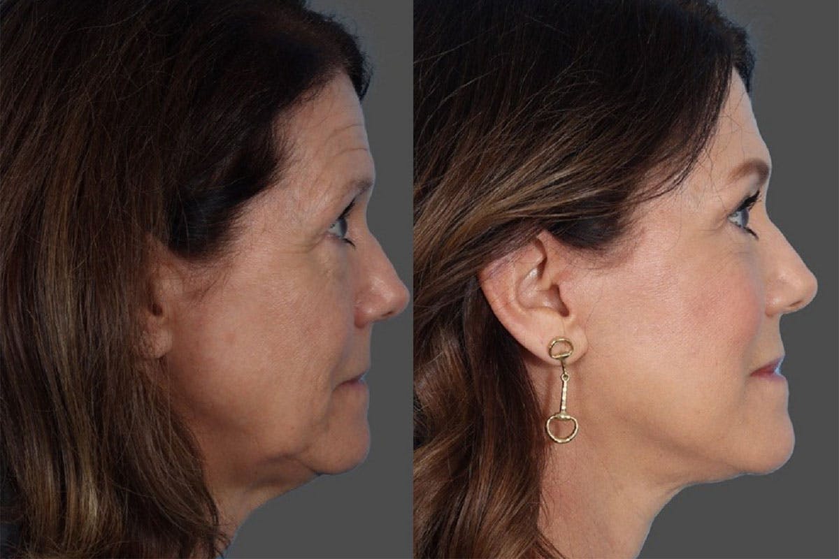 Facelift Before & After Gallery - Patient 242644 - Image 3