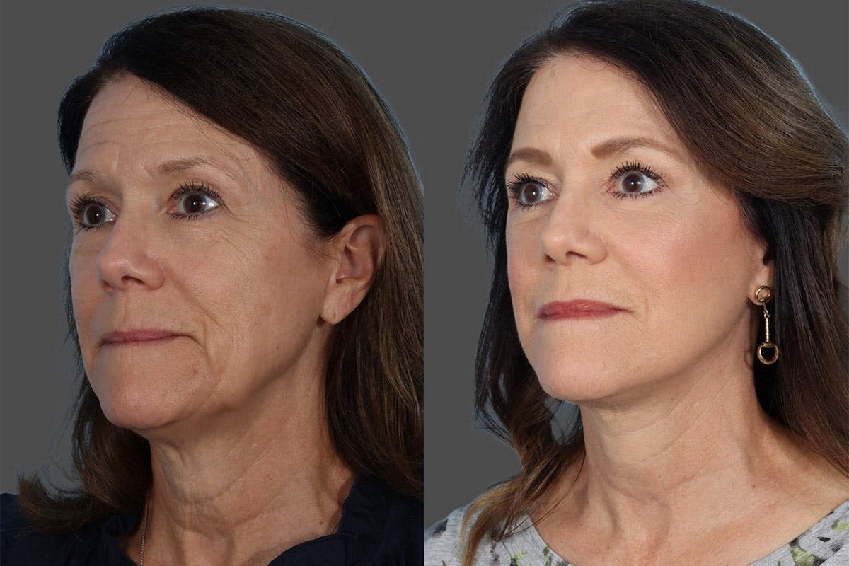 Facelift Before & After Gallery - Patient 242644 - Image 5