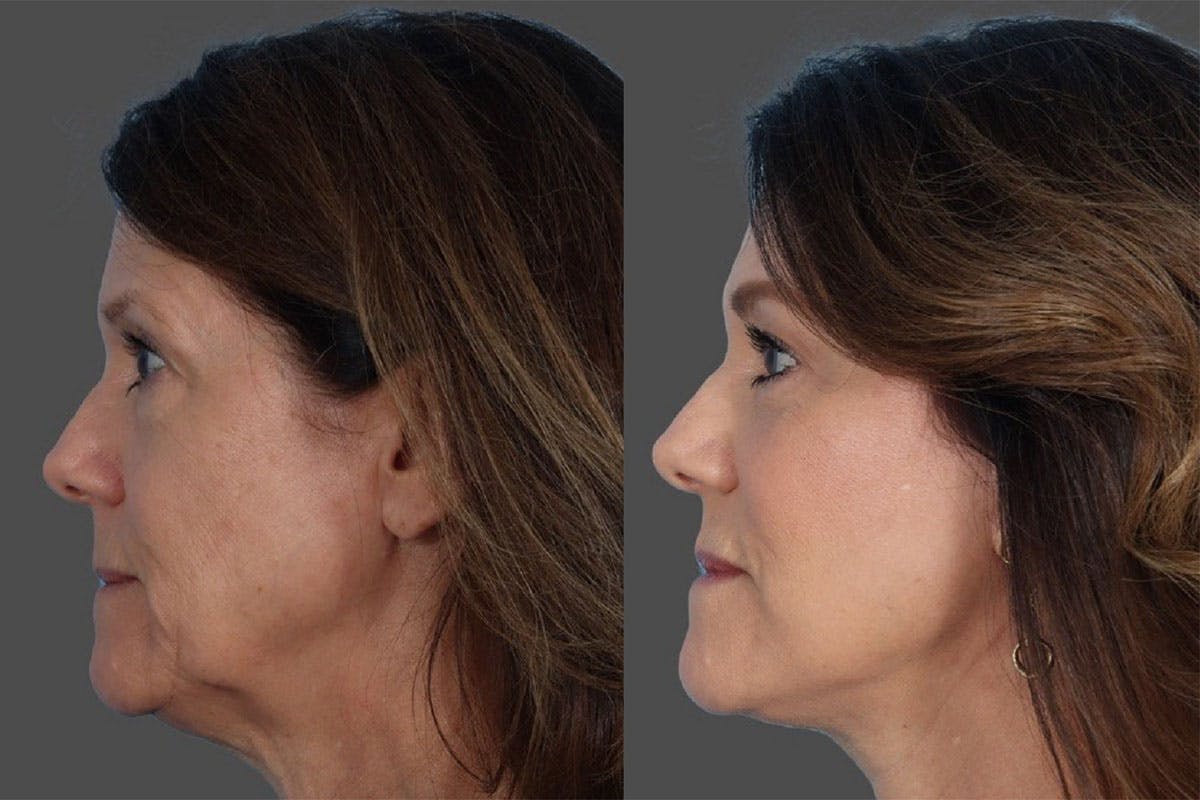 Facelift Before & After Gallery - Patient 242644 - Image 4