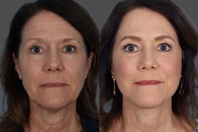 Facelift Before & After Gallery - Patient 242644 - Image 1