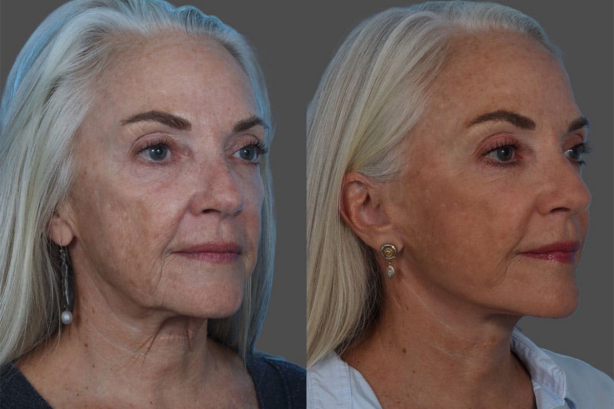 Facelift Before & After Gallery - Patient 206623 - Image 2