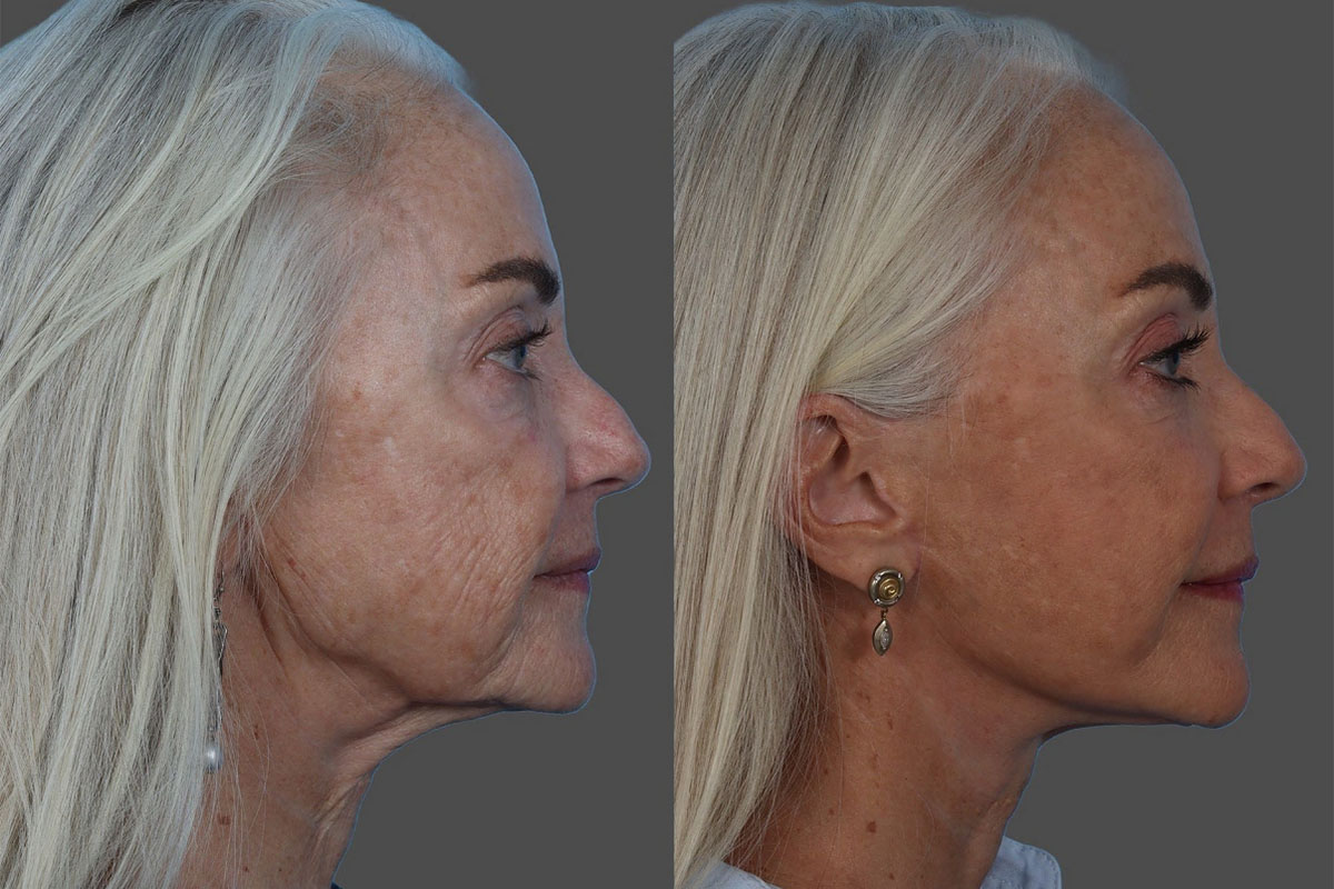 Patient 206623 | Facelift Before & After Photos | Buckingham
