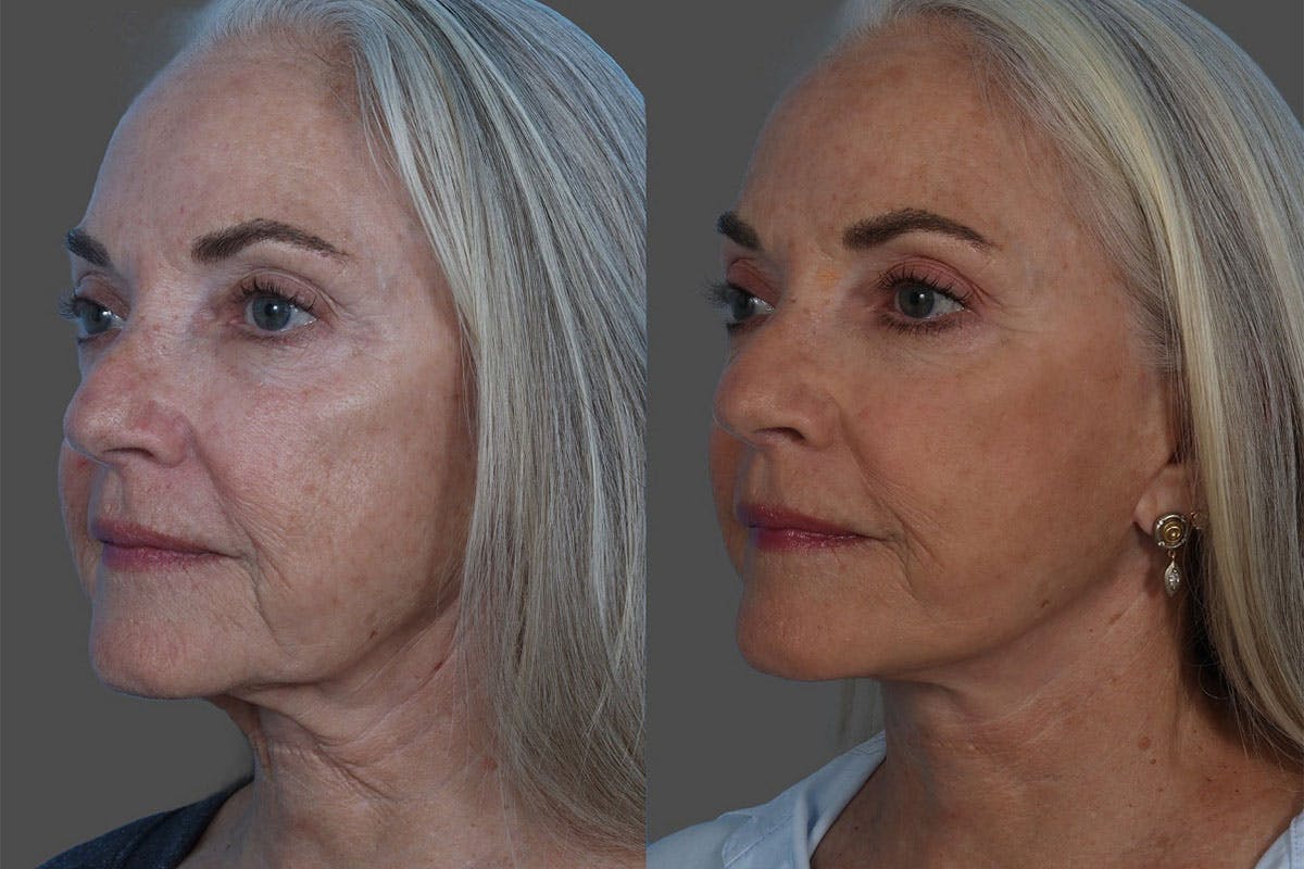Facelift Before & After Gallery - Patient 206623 - Image 5