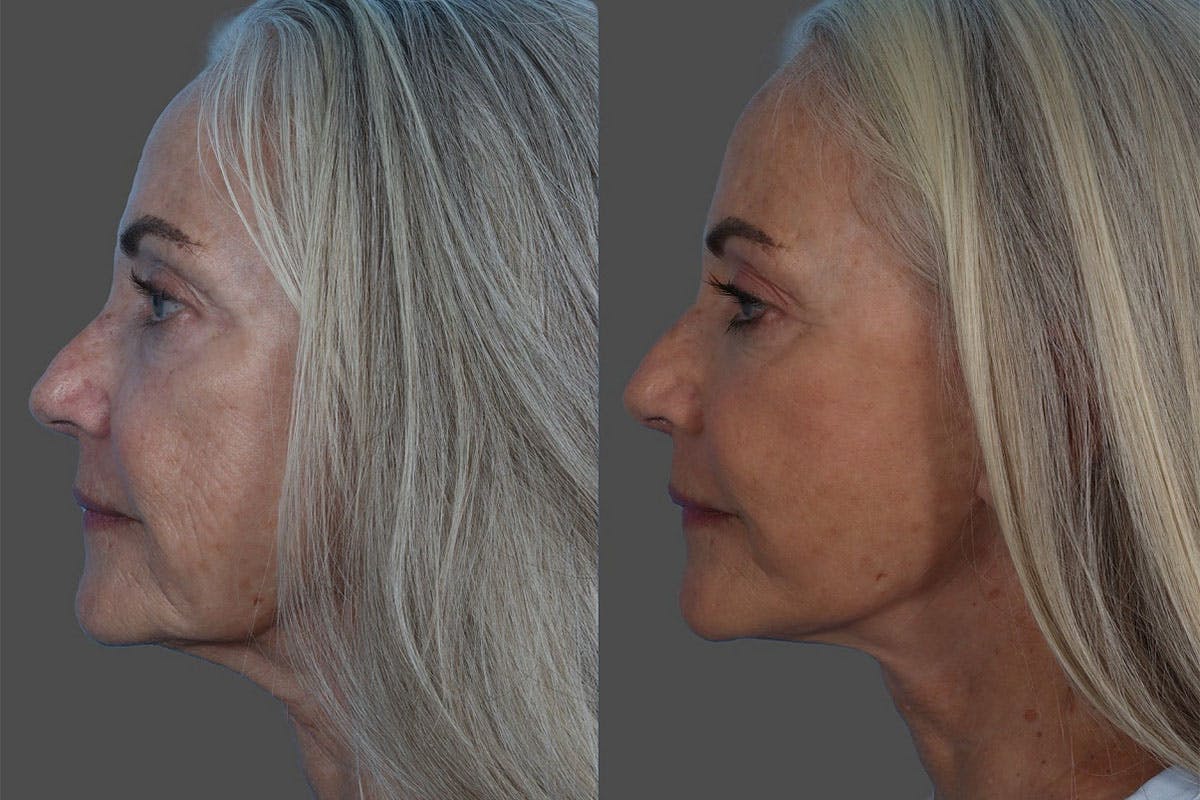 Facelift Before & After Gallery - Patient 206623 - Image 4