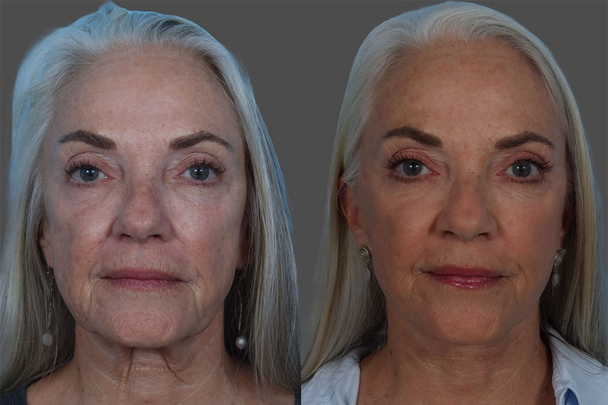 Patient 206623 | Facelift Before & After Photos | Buckingham