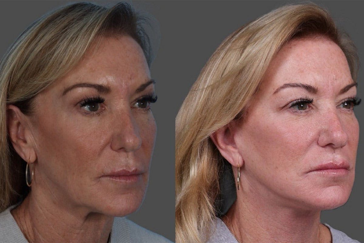 Facelift Before & After Gallery - Patient 361276 - Image 2