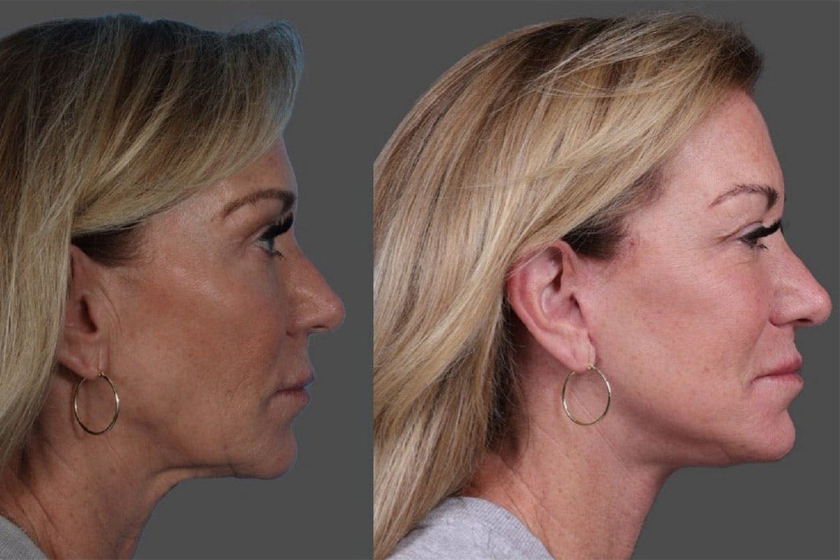Facelift Before & After Gallery - Patient 361276 - Image 3