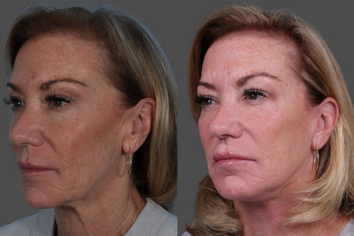 Facelift Before & After Gallery - Patient 361276 - Image 5