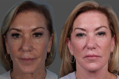 Facelift Before & After Gallery - Patient 361276 - Image 1
