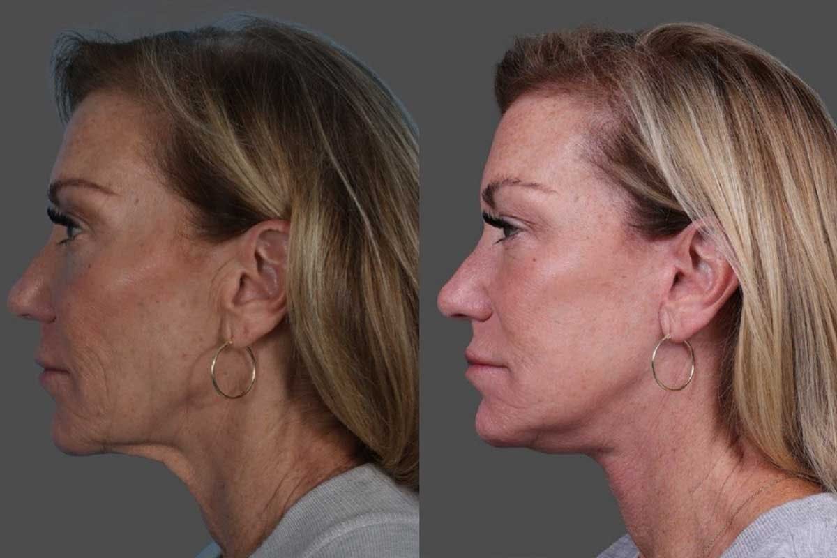 Facelift Before & After Gallery - Patient 361276 - Image 4
