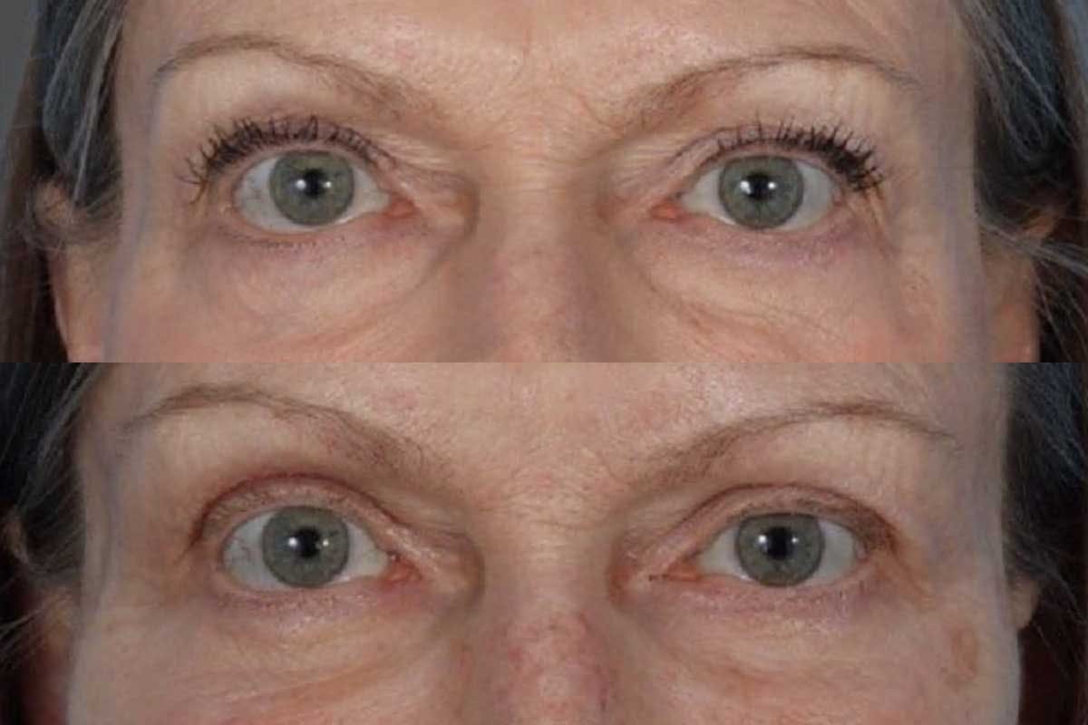 Eyelid Surgery (Blepharoplasty) Before & After Gallery - Patient 110844 - Image 6