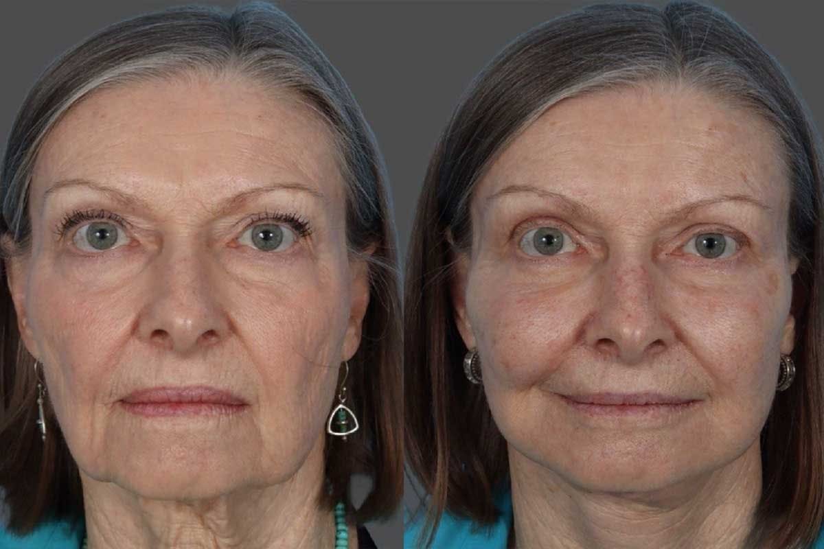Eyelid Surgery (Blepharoplasty) Before & After Gallery - Patient 110844 - Image 1