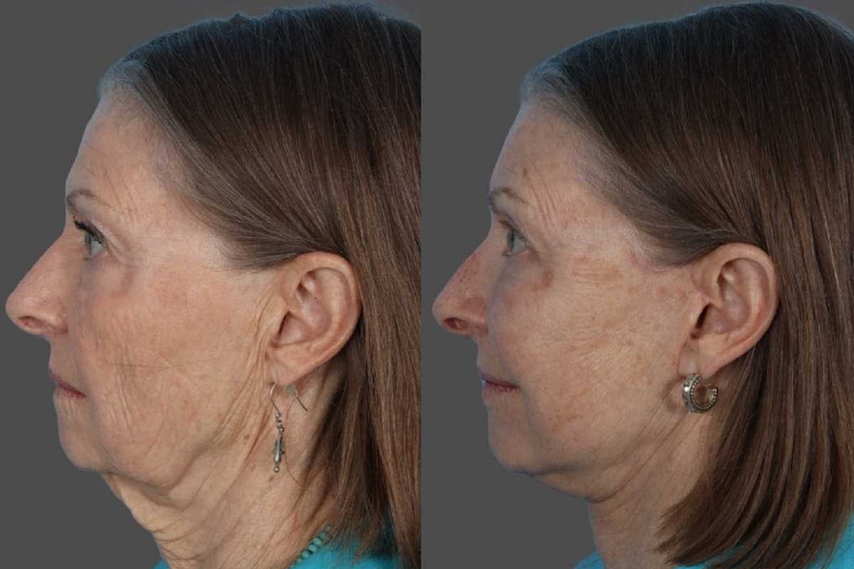 Eyelid Surgery (Blepharoplasty) Before & After Gallery - Patient 110844 - Image 2